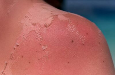 Cinci arsuri solare pot dubla riscul de melanom spun medicii