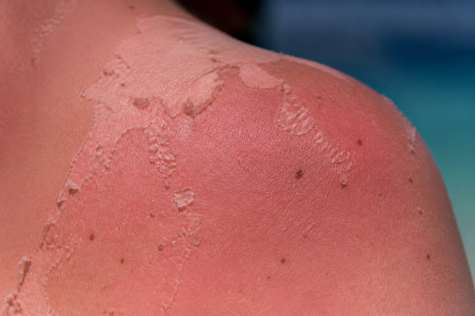 Cinci arsuri solare pot dubla riscul de melanom spun medicii