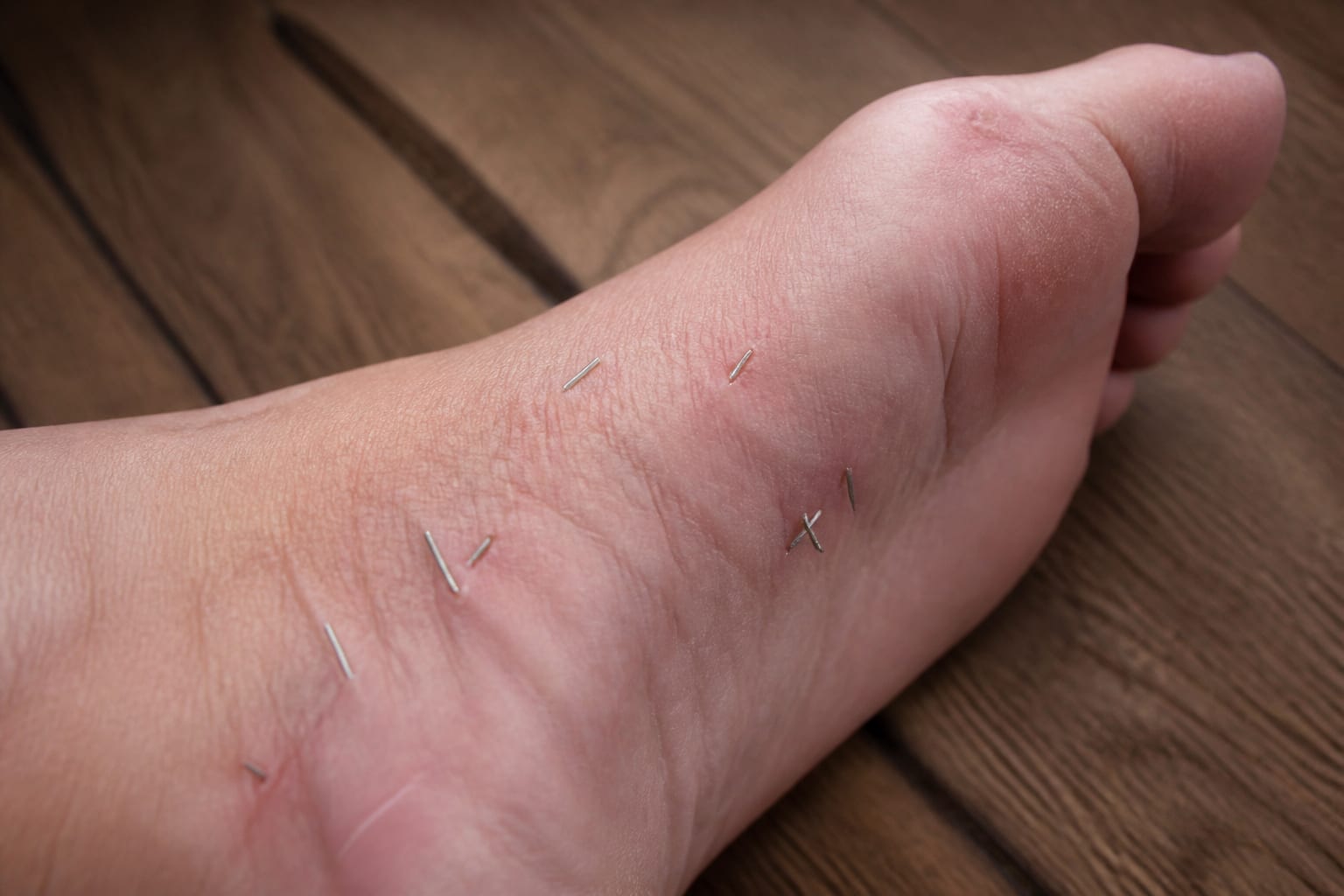 Ce se poate întâmpla la o ședință de acupunctură: o femeie a ajuns la spital cu peste zece ace rupte în picior